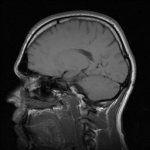 45515301 - prefrontal flattened.jpg