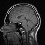 45515333 - prefrontal inside curve.jpg